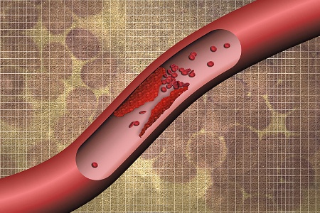 Finding Blood Clots Before They Wreak Havoc