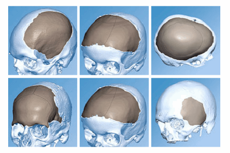 JJ Materialise Partner On 3D-Printed Custom Cranio-Facial