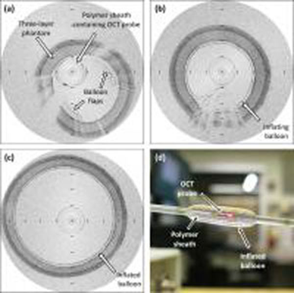 Optical Imaging Technique For Angioplasty