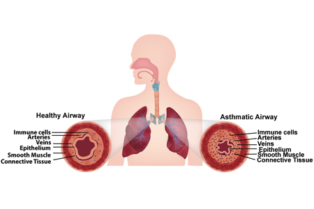 New “muscle-on-a-chip” Could Enable Patient-specific Asthma Treatments