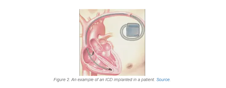 Understanding The Differences Between Pacemakers And ICDs   Knowles   Icd 