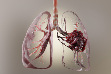 anatomical, anatomy, biology, lungs, cancer, disease-GettyImages-1501788964 anatomical, anatomy, biology, lungs, cancer, disease-GettyImages-1501788964