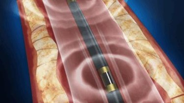 shockwave lithoplasty shockwave lithoplasty