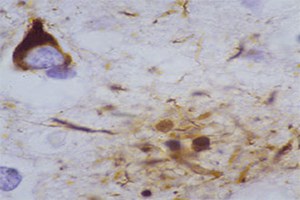 Tangle-and-plaque_primary