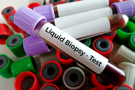 Liquid Biopsy Early Cancer Detection Diagnostics The Current Landscape