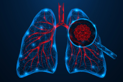 Human lung cancer under microscope-GettyImages-2207680068