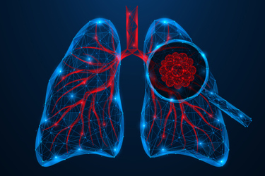 Human lung cancer under microscope-GettyImages-2207680068