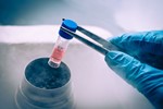 Stem Cell Therapy Trial Offers Hope To Osteoarthritis Patients Stem Cells (002)