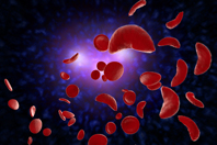 A Biotech Outsourcing For Sickle Cell Anemia Sickle cell anemia disease-iStock-1266187249