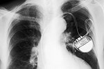 New Gene Therapy Could Make Electronic Pacemakers Passé  Pacemaker