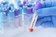 GettyImages-2156218287-vial-blood-sample-liquid-biopsy