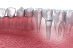 Dental Implant