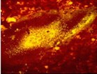 measles measles