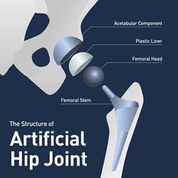 DePuy Synthes Bringing Hip Surgery To The Front