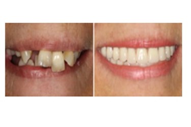 Invisalign Cost - Cosmetic Dentistry in Oxnard CA