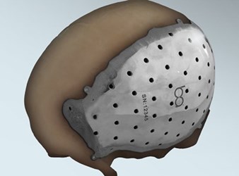 cranial implant