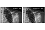 Canon Medical - PR - Shoulder w-o  w Intelligent NR