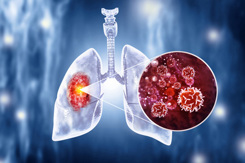 Medical Illustration lung cancer-GettyImages-1440172069