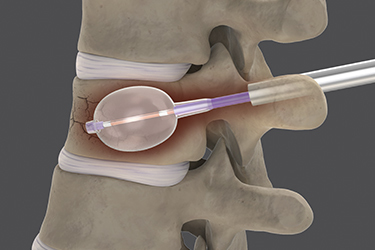 mdo-featured-articles-modern-balloon-catheters