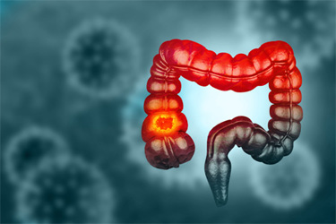 GettyImages-1498920580 Colon cancer