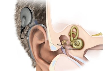 cochlear implant cochlear implant
