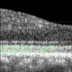 Optoretinography of human retina