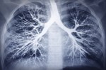 Janssen And Aduro Ink New Deal In Lung Cancer Immunotherapy lungs 450x300