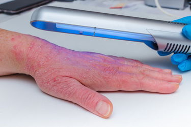 Phototherapy dermatosis-GettyImages-1164684003