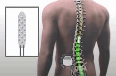 Spinal Cord Stimulation, CorTec