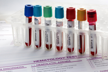 tubes with blood samples, hematology test-GettyImages-1443027500