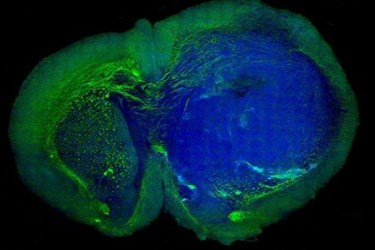 New Laser-Based Tool Could Dramatically Improve The Accuracy Of Brain ...