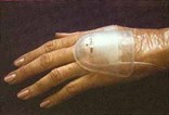 Intravenous Site Protectors Intravenous Site Protectors