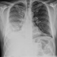 New Two-Drug Approach To Treat Type Of Respiratory Disease