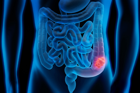 More Focus And Funding Becomes Crucial To Curing Colorectal Cancer - Vimarsana News