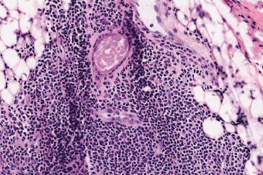 ICR Breast Cancer Hotspots ICR Breast Cancer Hotspots