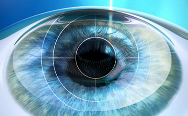 Bausch Lomb IBM Develop App To Assist Cataract Surgeons