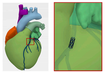 stent stent