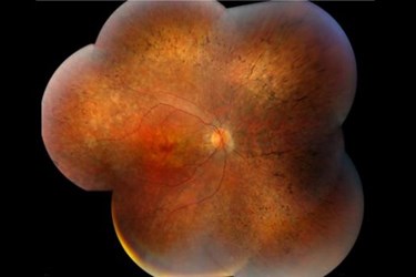 Diffused Pigmentary Retinal Degeneration