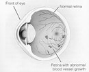 Scientists Identify Natural Chemical That Causes Blinding Blood Vessel Growth Scientists Identify Natural Chemical That Causes Blinding Blood Vessel Growth