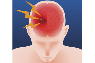 Headache, cerebral hemorrhage, brain stroke-GettyImages-609441144