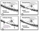 Human Monoclonals Induce Remyelination in Mouse Model