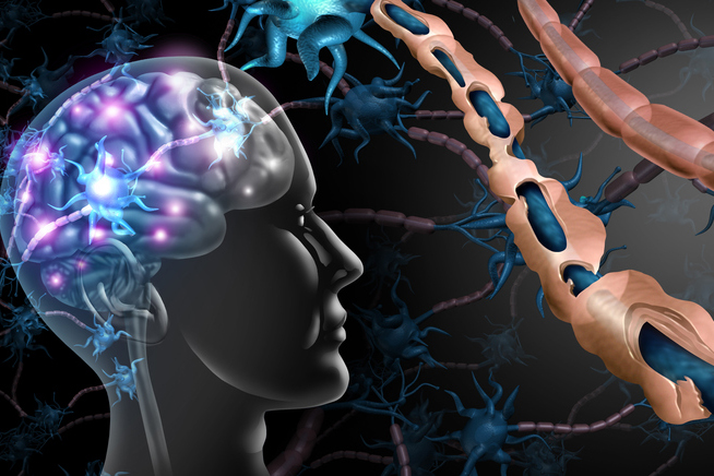 Harnessing The Power Of AI In MS Diagnosis Monitoring And Treatment - Vimarsana News