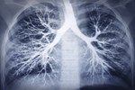 Ariad's Lung Cancer Drug Gets FDA Breakthrough Status  lungs450x300