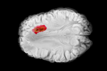 Glioblastoma in Left Frontal Lobe with Midline Shift-GettyImages-2226756753