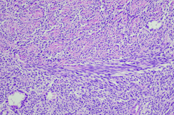 Cancer, Synovial sarcoma-GettyImages-1416092649