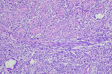 Cancer, Synovial sarcoma-GettyImages-1416092649 Cancer, Synovial sarcoma-GettyImages-1416092649