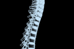 Spinal x-ray-GettyImages-172132090