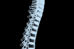 Spinal x-ray-GettyImages-172132090