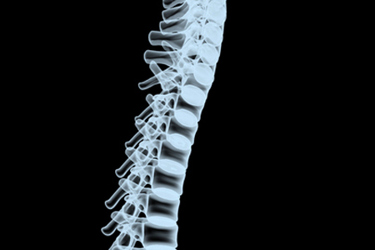 Spinal x-ray-GettyImages-172132090 Spinal x-ray-GettyImages-172132090