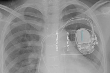 CHLA Pediatric Pacemaker